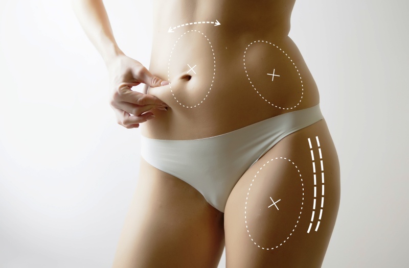 SculpSure vs. Liposuction: Choosing the Right Body Contouring Option for  You - Ascent Laser Aesthetics