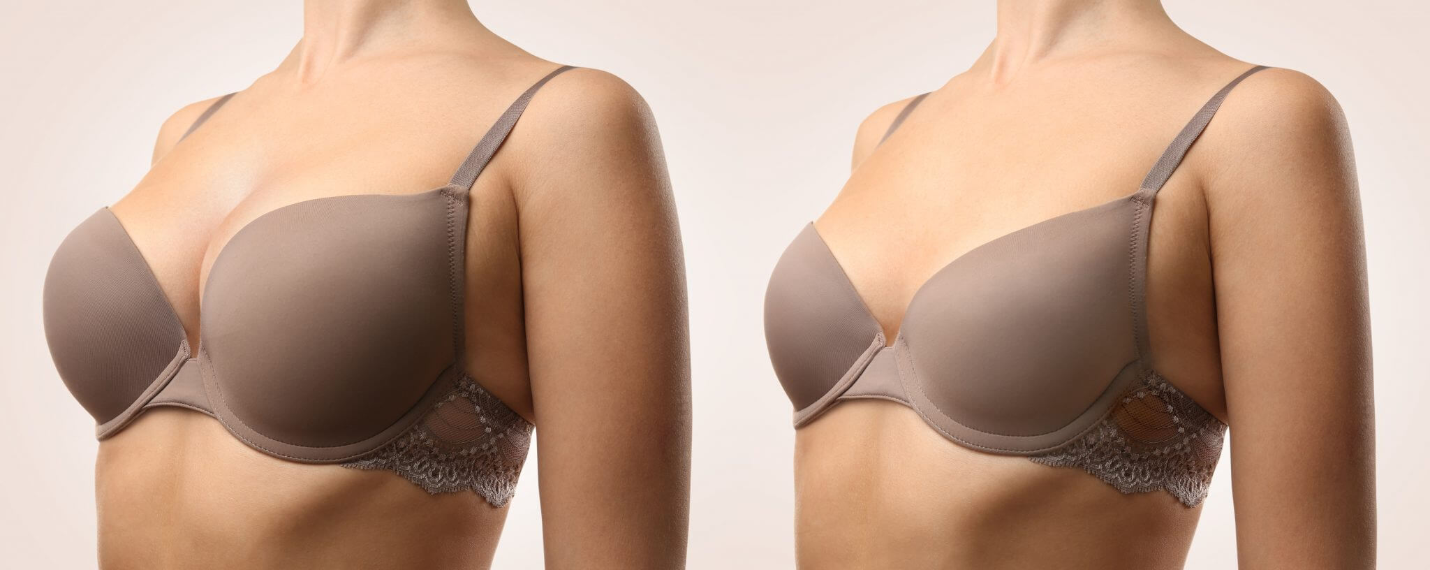 How to Reduce Cup Size from D to B with Breast Reduction