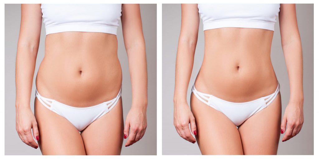 Female body before and after treatment