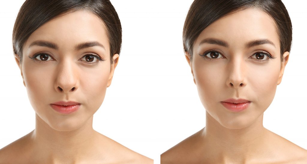 Young woman before and after rhinoplasty