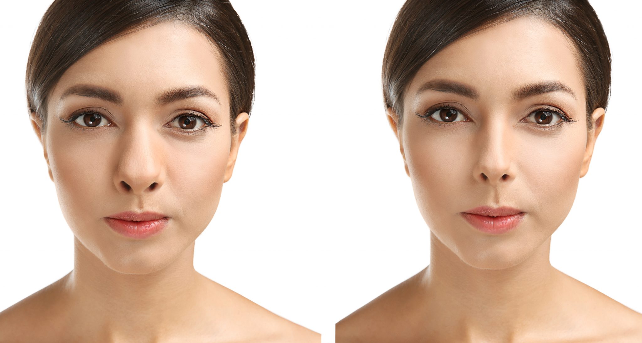 Young woman before and after rhinoplasty.