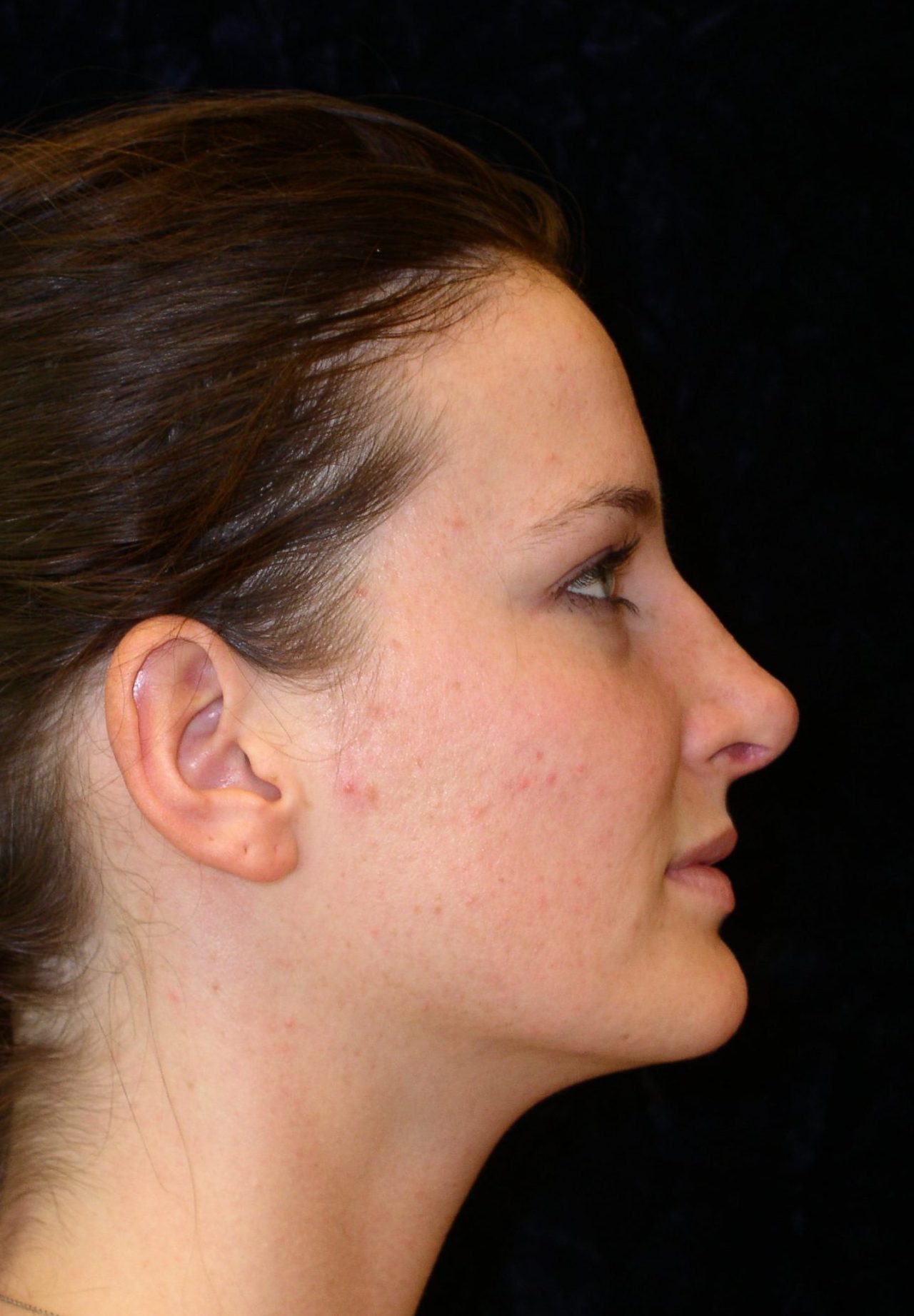 after rhinoplasty side view