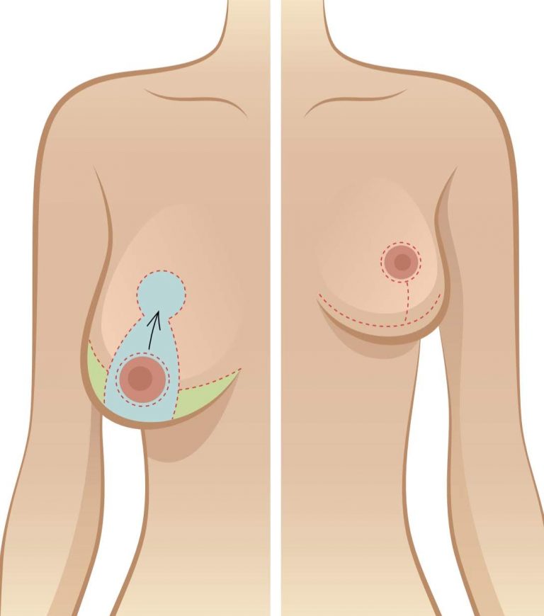 a large breast is overlaid by an arrow pointing to where it should be corrected to go to while a small breast looks nice