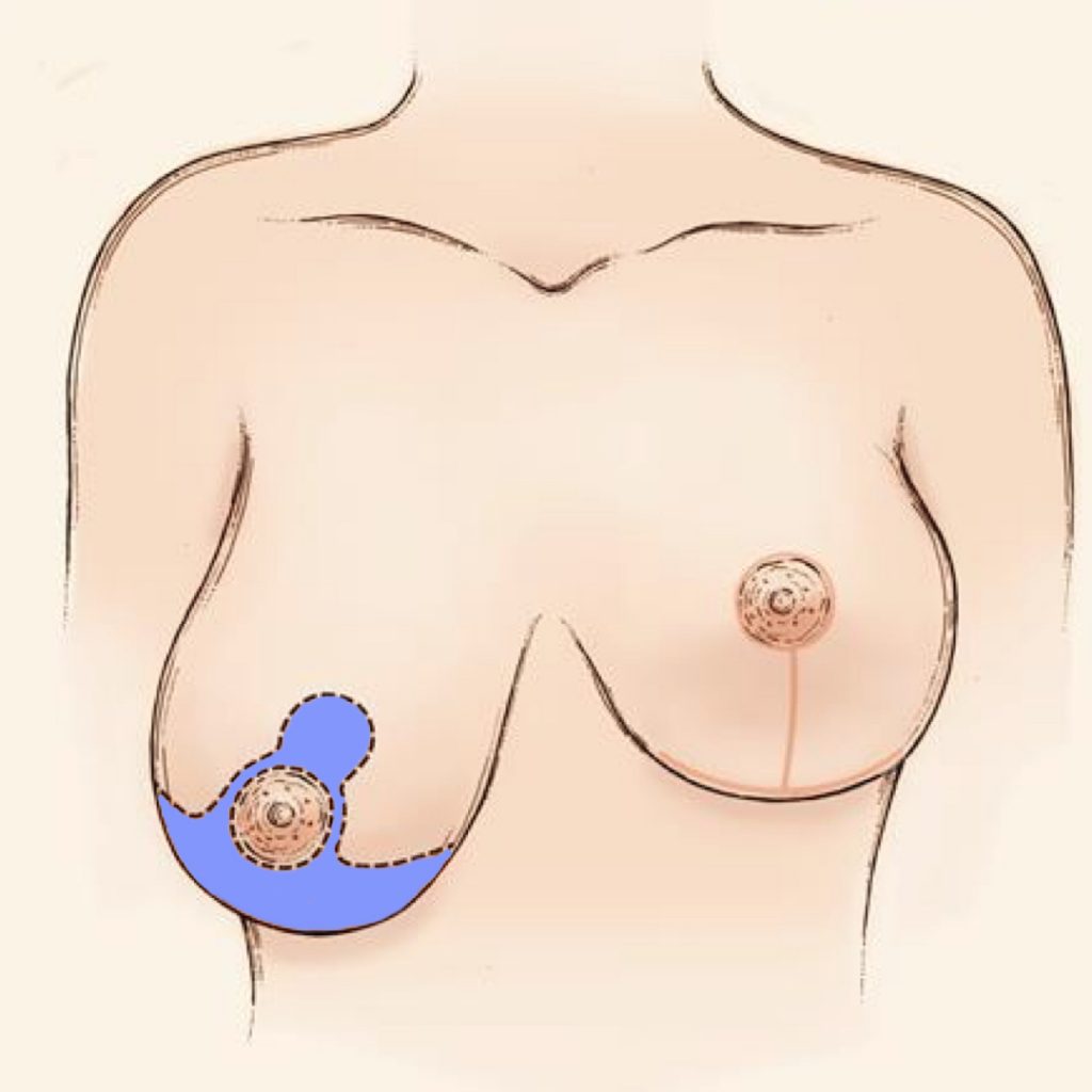 anchor incision breast reduction