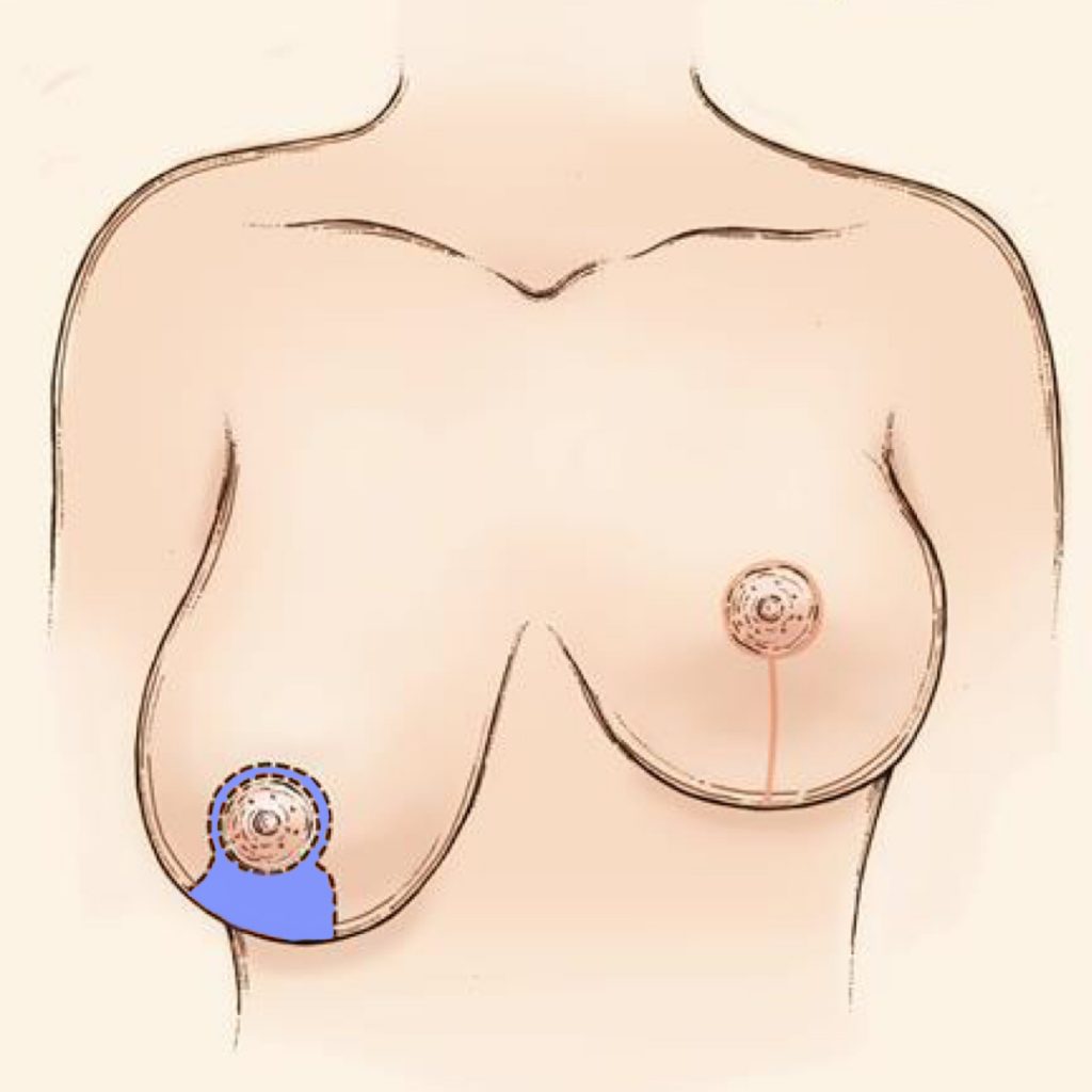 lollipop incision breast reduction
