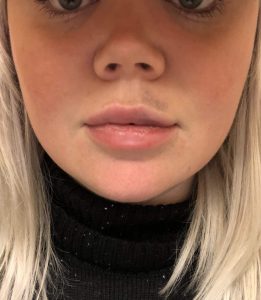 2 days after lip augmentation