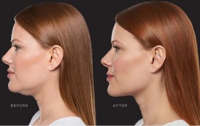 KYBELLA Before and After Chin Sculpting