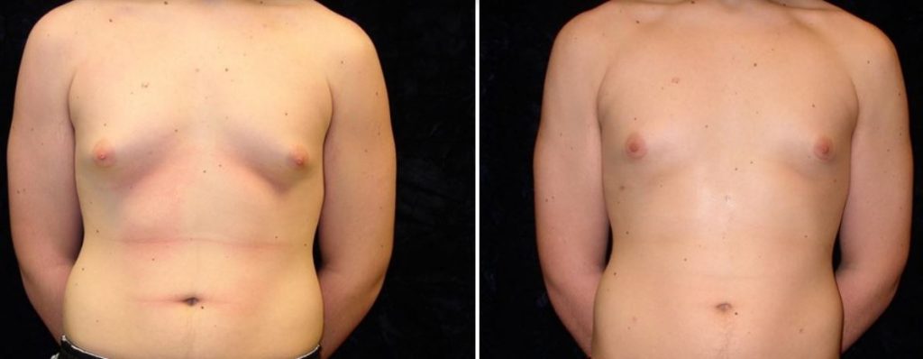liposuction-review-photo-aesthetica-dr-chang