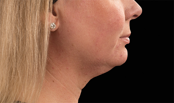 Neck Fat Removal coolsculpting