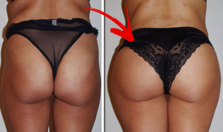 Before and after Butt Augmentation