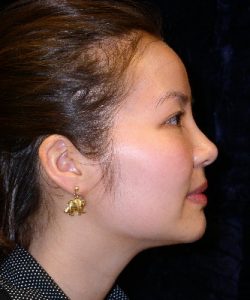 Before Nonsurgical Rhinoplasty Virginia