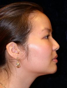 After Nonsurgical Rhinoplasty
