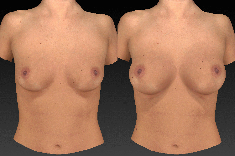 Vectra 3 D imaging before and after breast augmentation