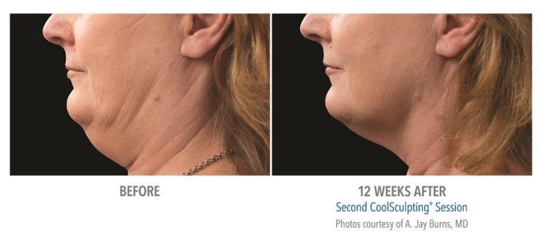 coolsculpting neck before and after