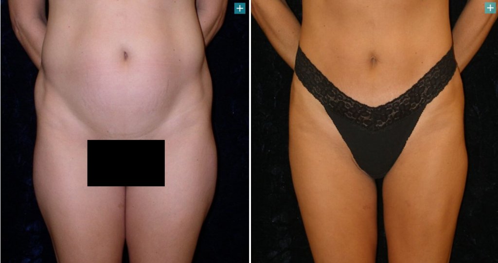 liposuction censored