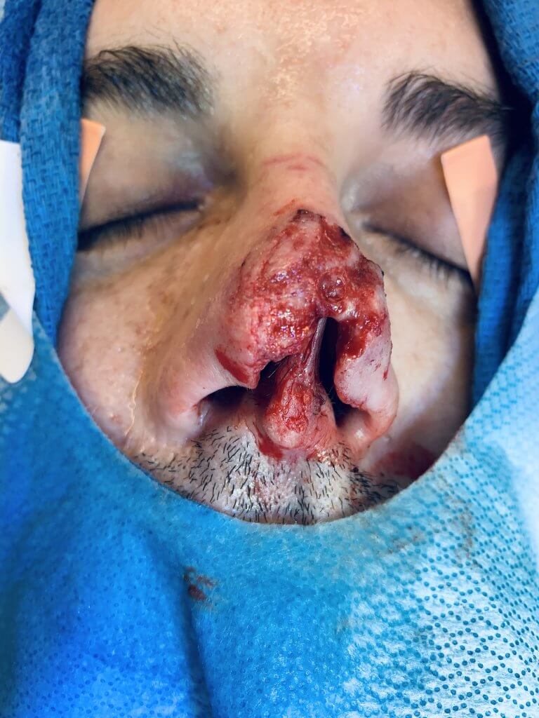 before nasal reconstruction after dogbite leesburg, virginia