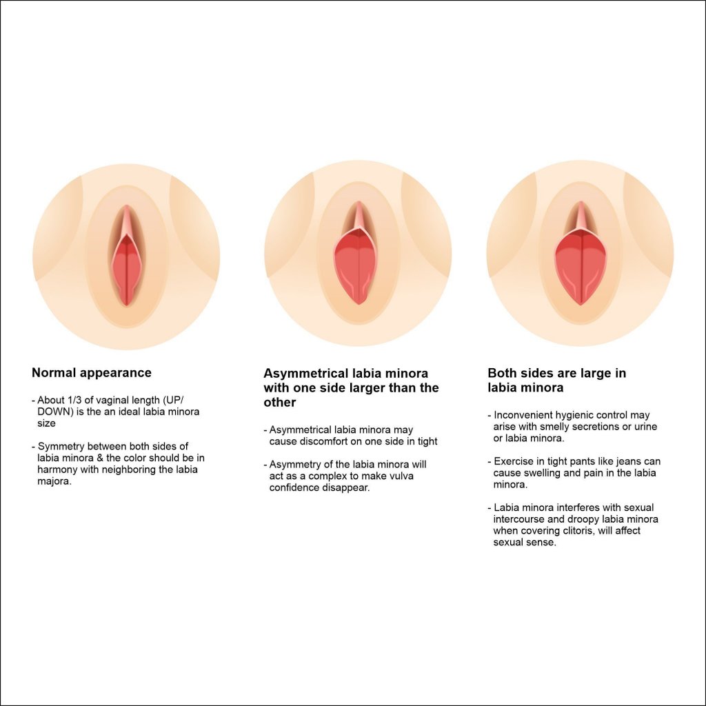 When Will Swelling Go Down After Labiaplasty Surgery?