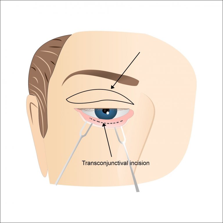 Lower Eyelid Surgery