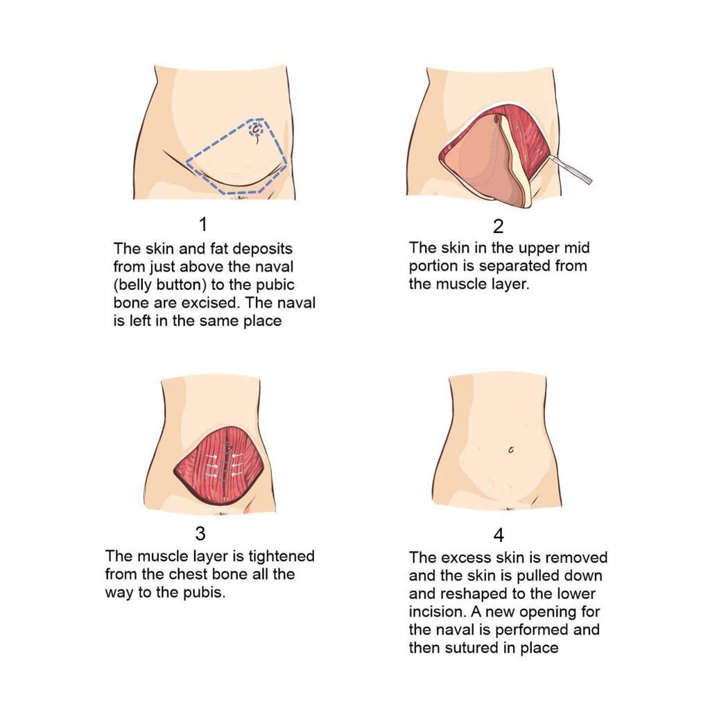 Tummy Tuck illustration