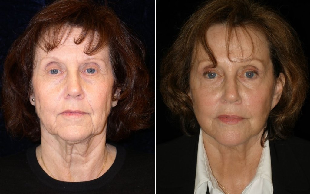 Mini Facelift Before After Photos Patient 40505