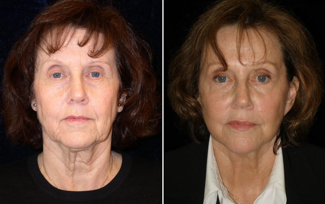 Mini Facelift Before After Photos Patient 40505