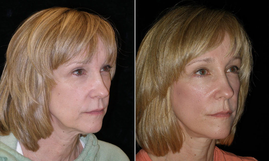 Facelift without Surgery!  Instant Facelift Over 50 