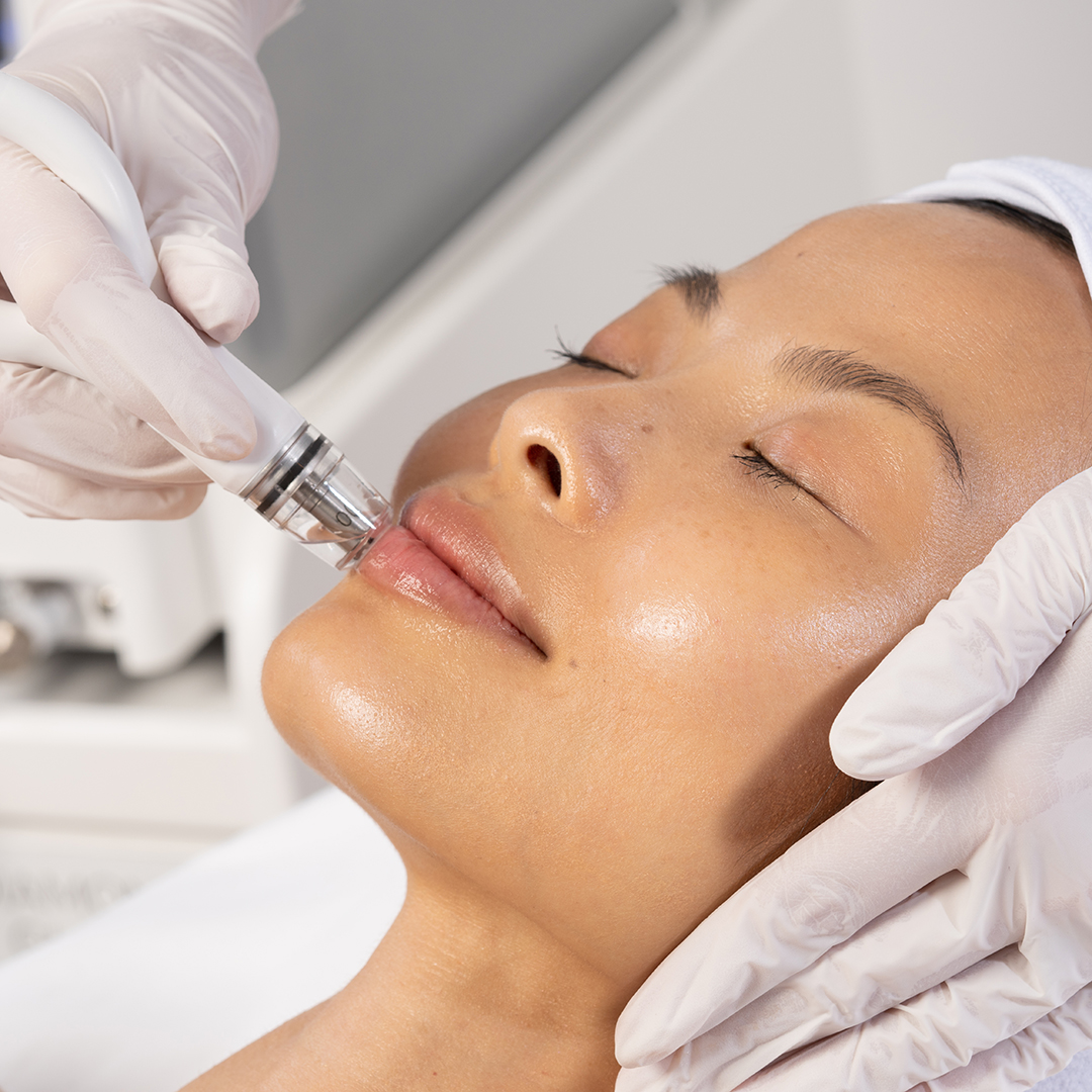 Chemical Peels vs Laser Treatment: Which Would Work Best for You?