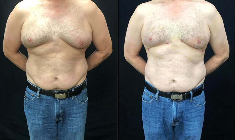 How Can Chest Contouring Enhance Your Physique?