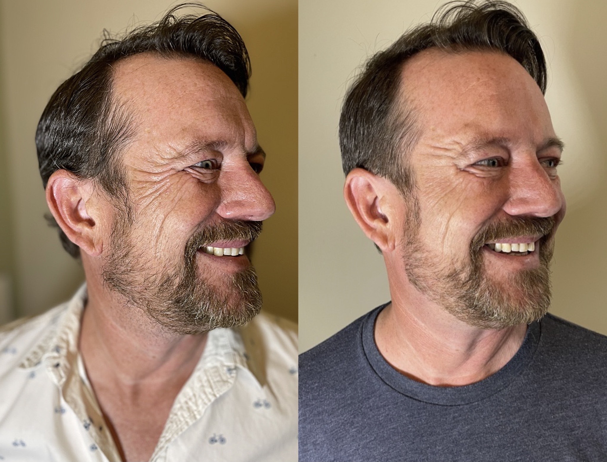 Botox® On A 50yo Male Patient Aesthetica Cosmetic Surgery And Laser Center