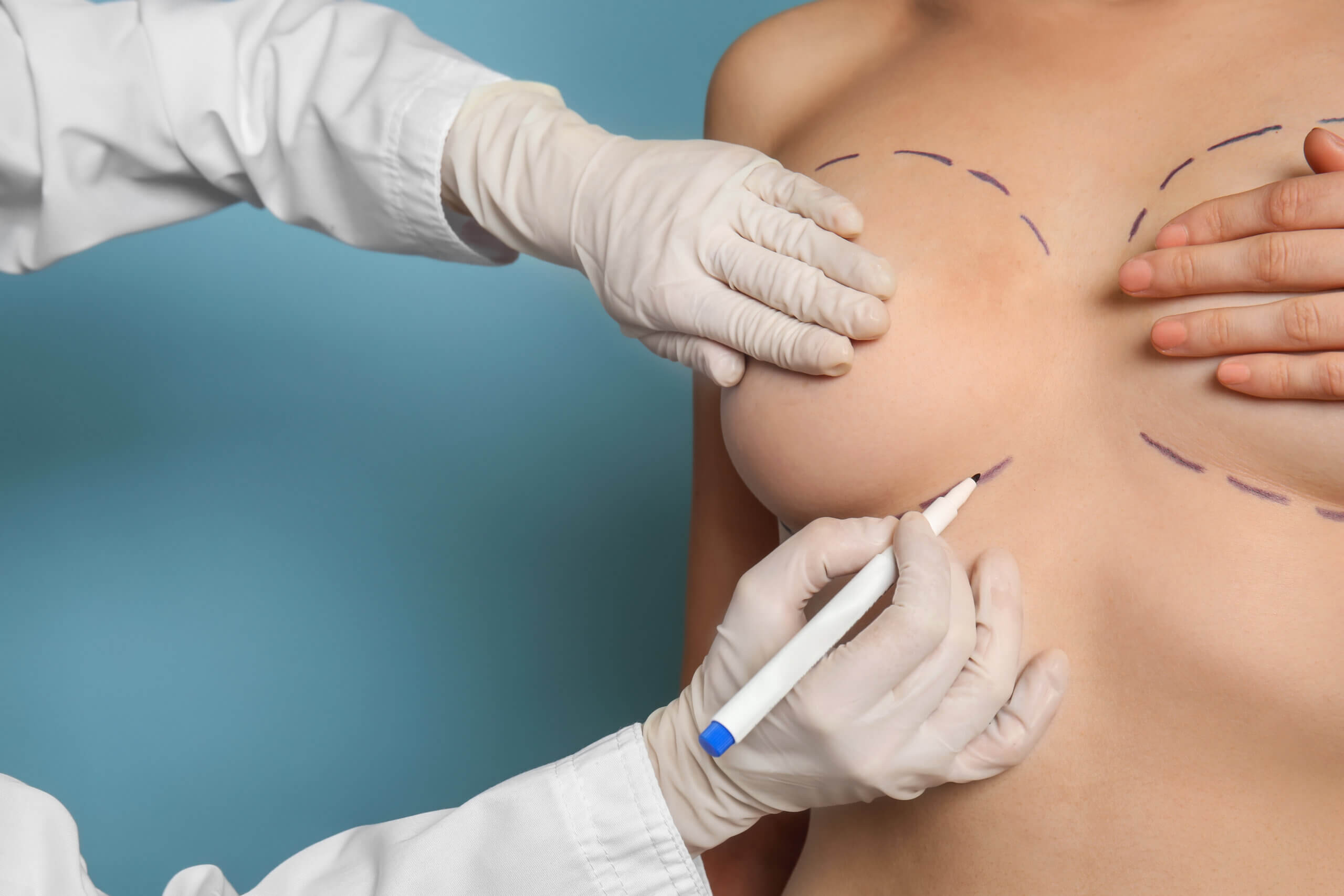 Combining Breast Reduction With Breast Lift