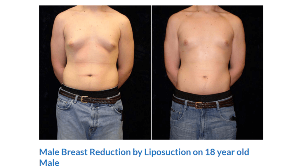 Gynecomastia Before & After Gallery: Patient 80