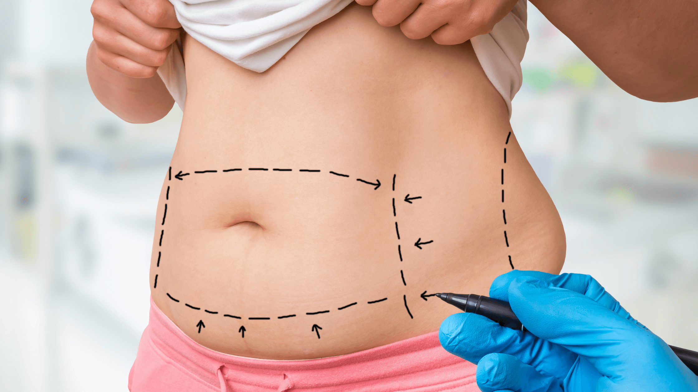 4 Questions to Ask Before Tummy Tuck Surgery - Basu Aesthetics