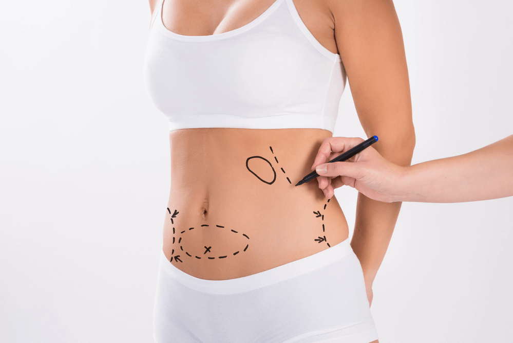 Is Abdominoplasty the Right Choice for You? Pros and Cons To Consider