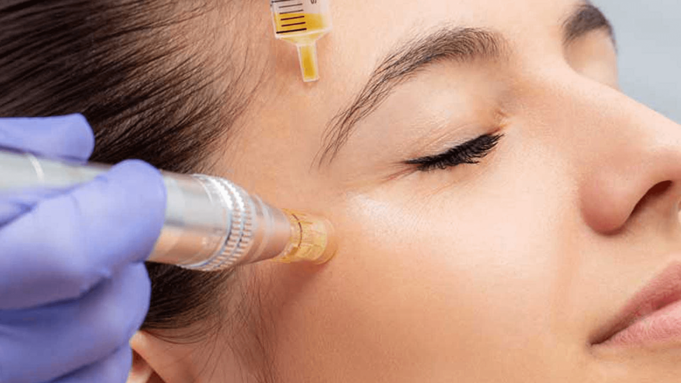Microneedling With PRP: The Solution for Your Acne Scars!