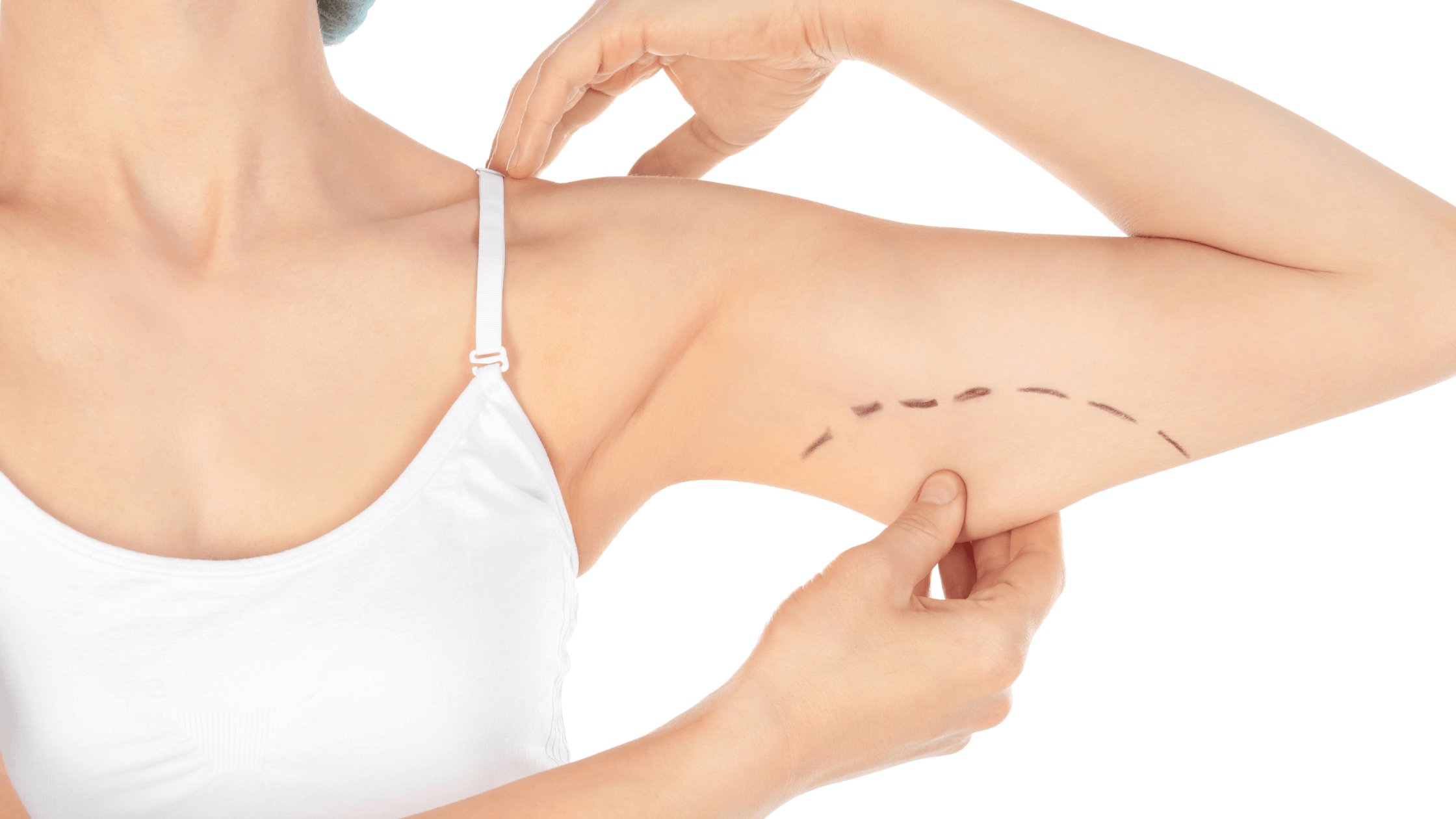 What is Arm Lift Surgery Recovery Like?