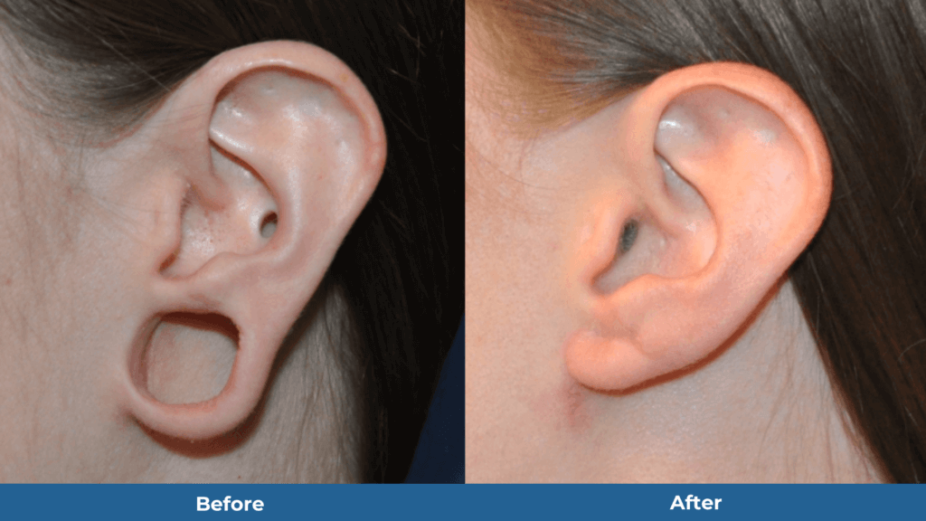 Ear Restoration Surgery After Tunnels And Ear Gauging 7724