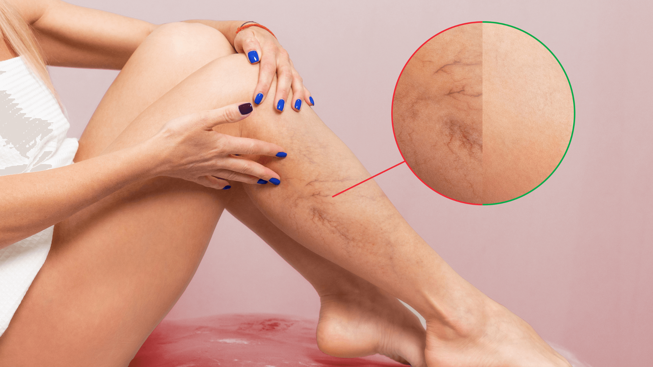 Are You Hiding Your Leg Veins? Try Laser Vein Removal!