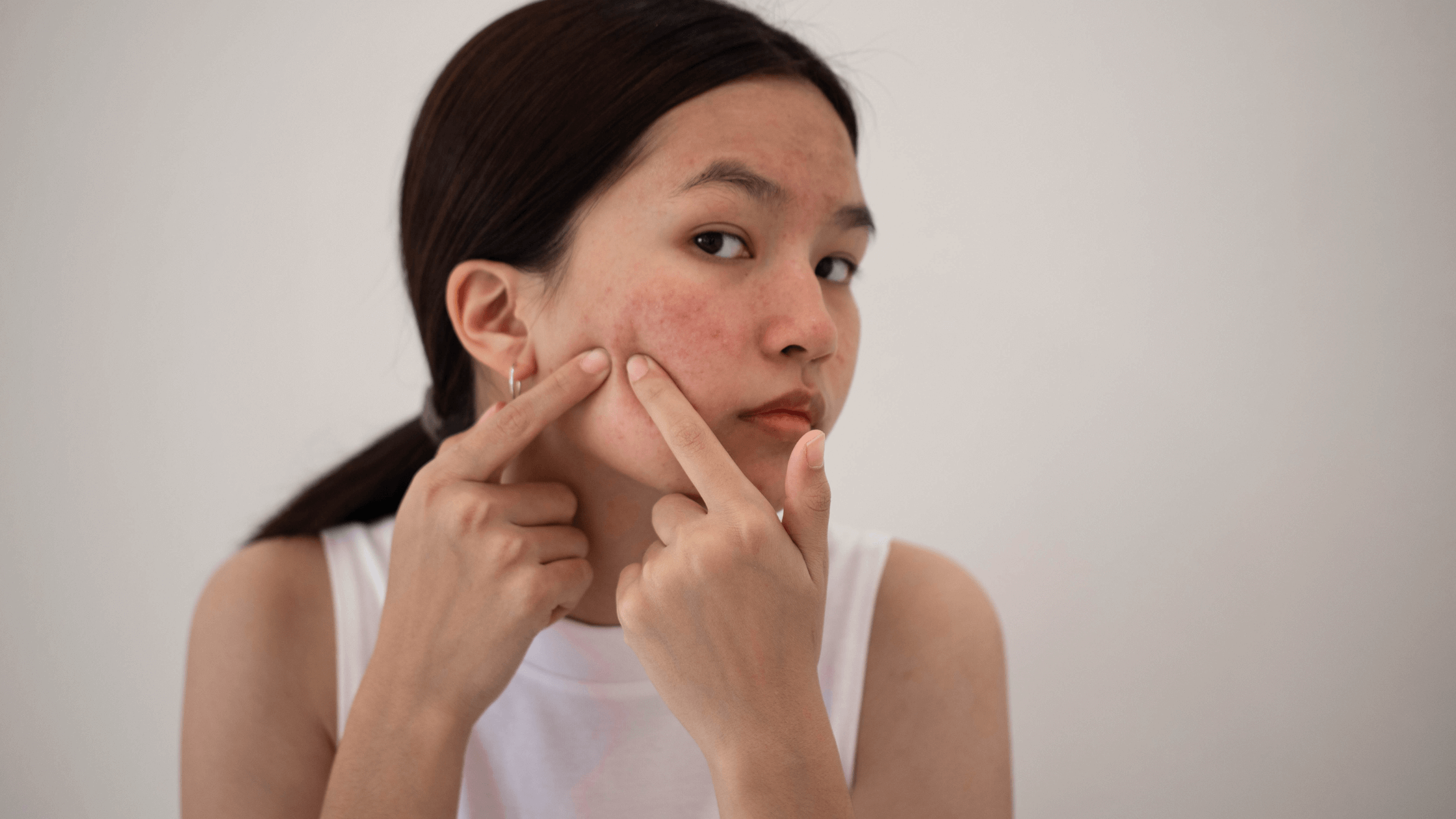 Is Your Acne Itchy? Try These 3 Treatments!