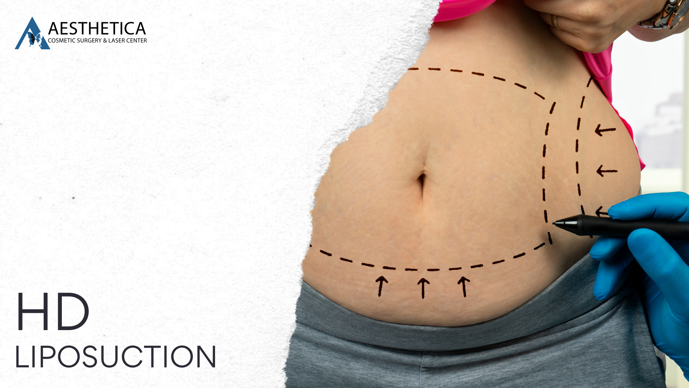 What Is High-Definition Liposuction?