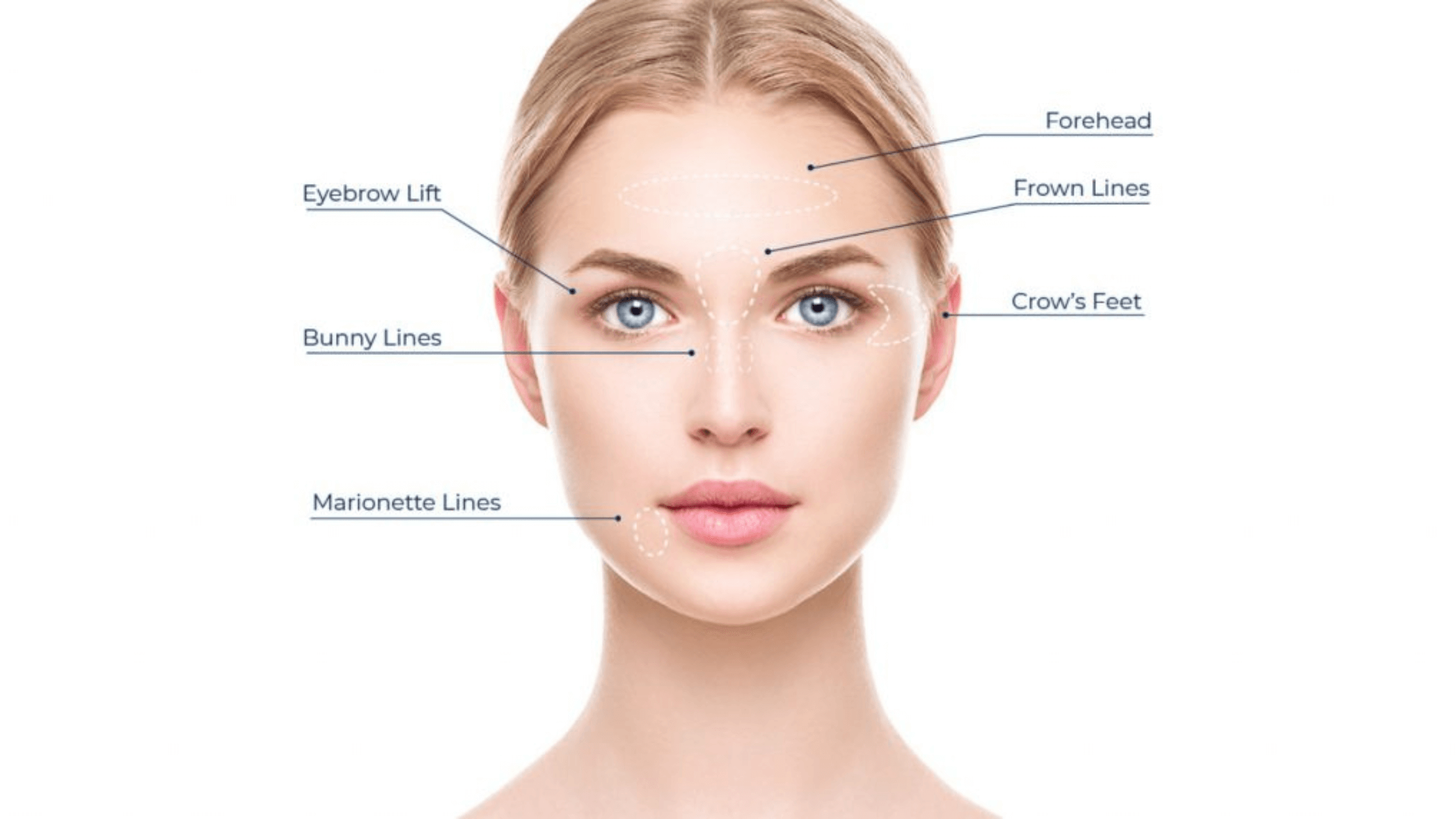 Selecting the Right Facial Zones for DAXXIFY Treatments
