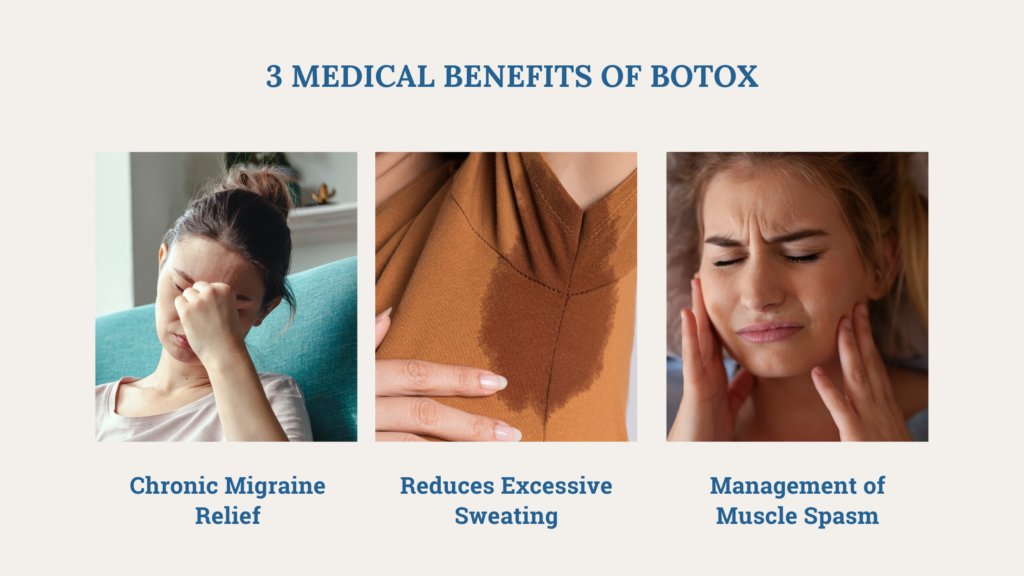 A composite image presenting three medical benefits of BOTOX. On the left, a woman is depicted holding her forehead, suggesting a migraine, with the label 'Chronic Migraine Relief'. The center image shows a close-up of a shirt under the arm with a sweat stain, with the caption 'Reduces Excessive Sweating'. On the right, a woman appears to be touching her cheeks and grimacing in pain, with the label 'Management of Muscle Spasm'. The top of the image reads '3 MEDICAL BENEFITS OF BOTOX' in bold lettering.