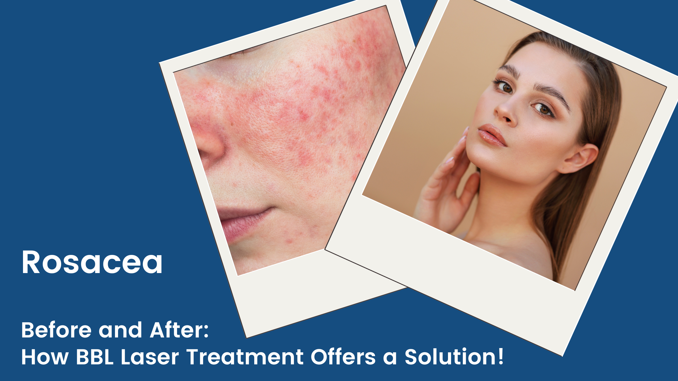 Rosacea Before and After: How BBL Laser Treatment Offers a Solution!