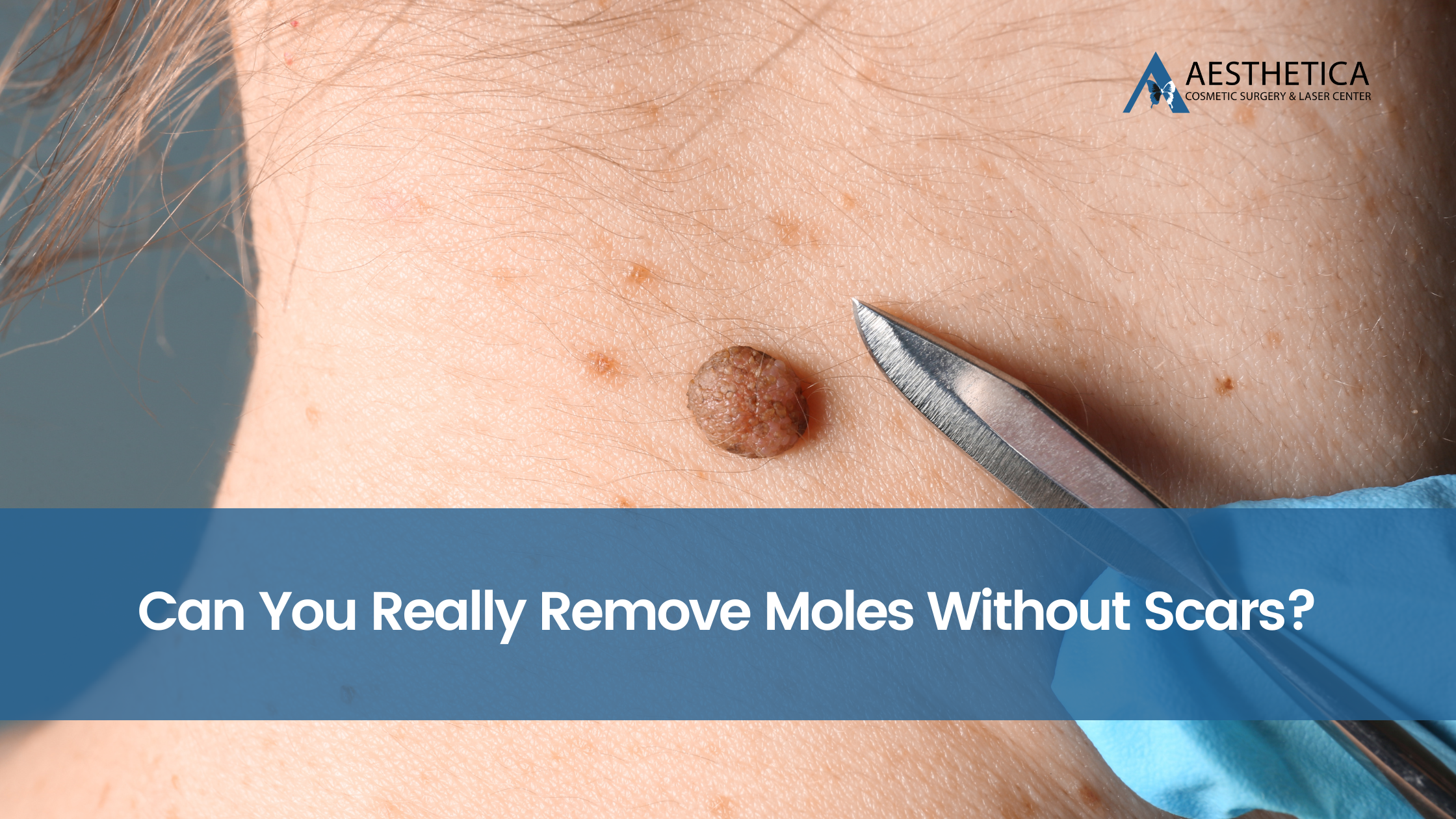 Can You Really Remove Moles Without Scars?