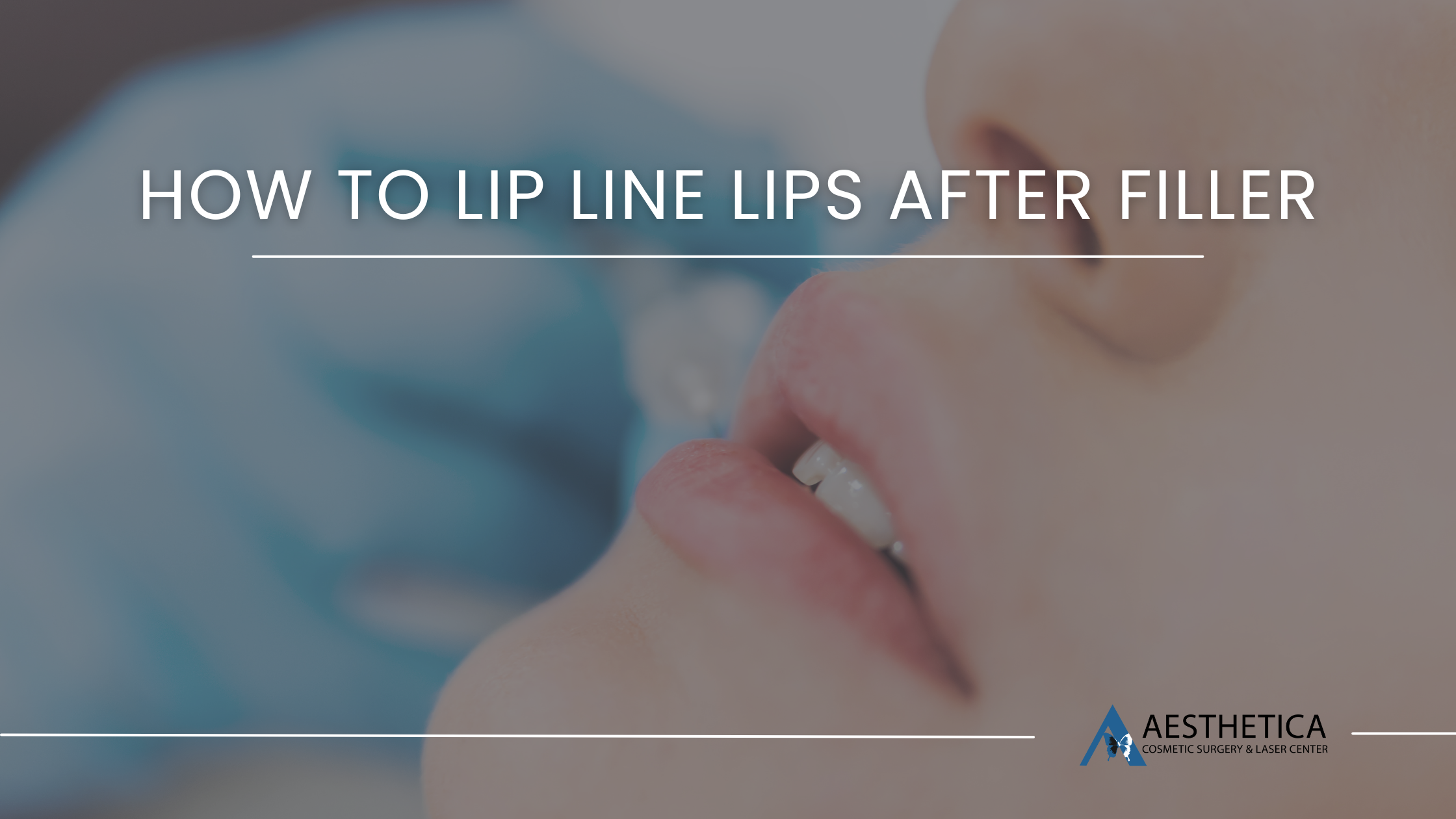 How To Lip Line Lips After Filler