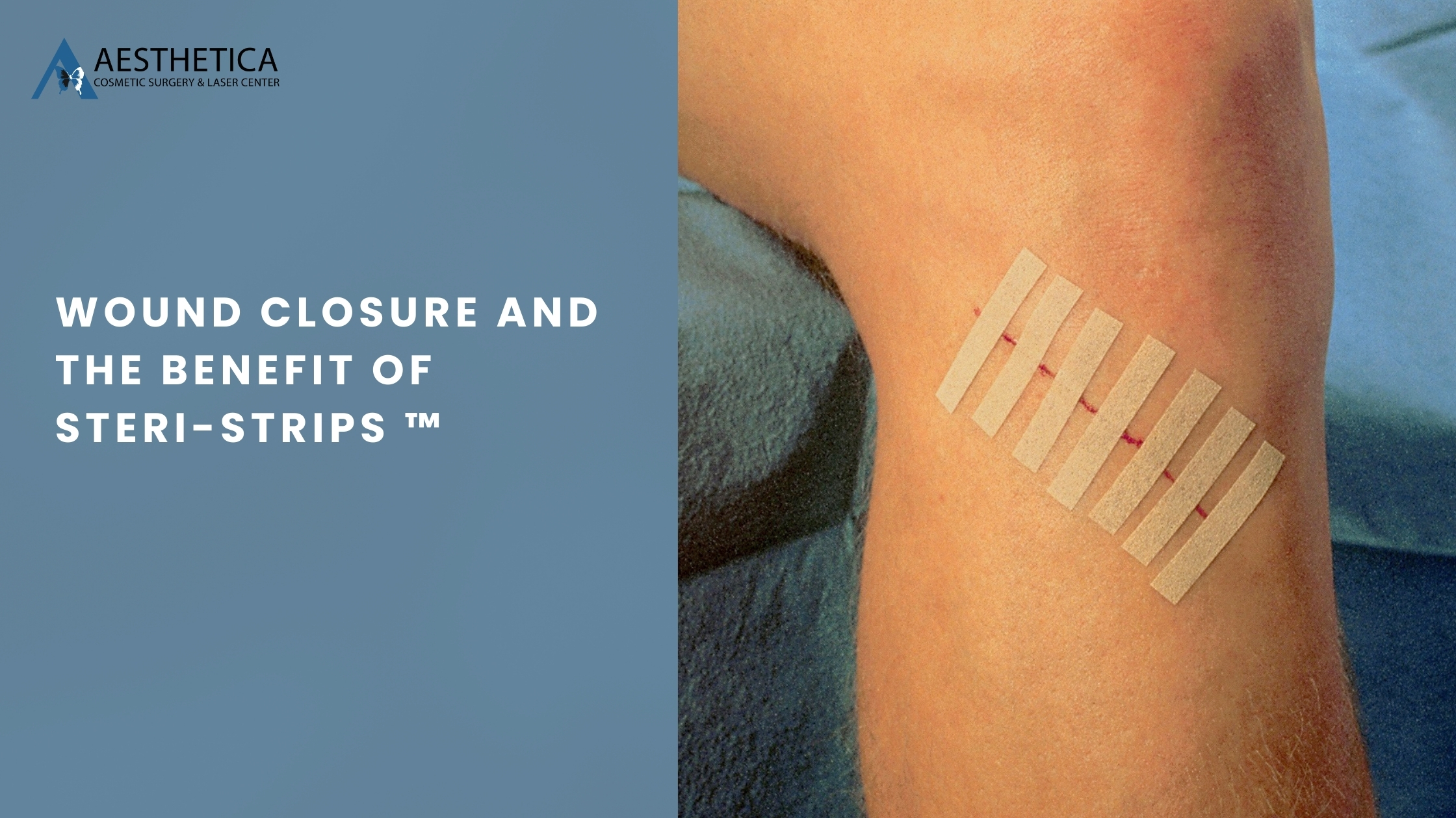 Wound Closure And The Benefit Of Steri-Strips ™