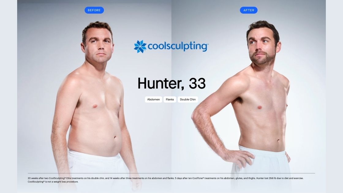 sculpt touch glp-1 reviews before and after Why CoolSculpting® is the Secret to Post-Weight Loss Success