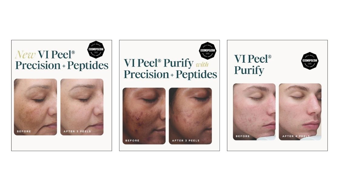 VI Peel,Chemical Peels,Facials,Skin Care