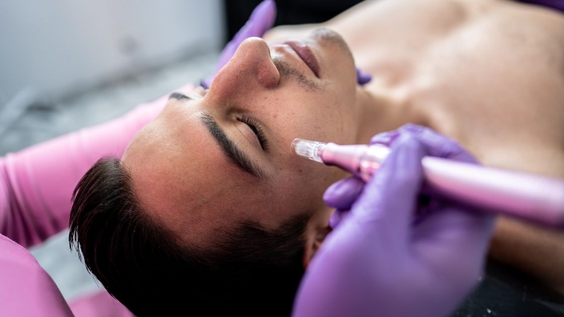 dermatologistaesthetician using a microneedling equipment on a patient at clinic